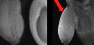 O pênis do jovem tinha um formato incomum, como de uma bola de futebol americano, segundo o médico Rafael Carrion (Foto: Reprodução/Journal of Sexual Medicene)