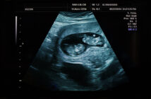 cromossomos XY, DNA XX