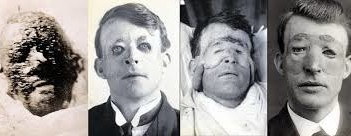 Walter Yeo - A foto mostra antes e depois da cirurgia.