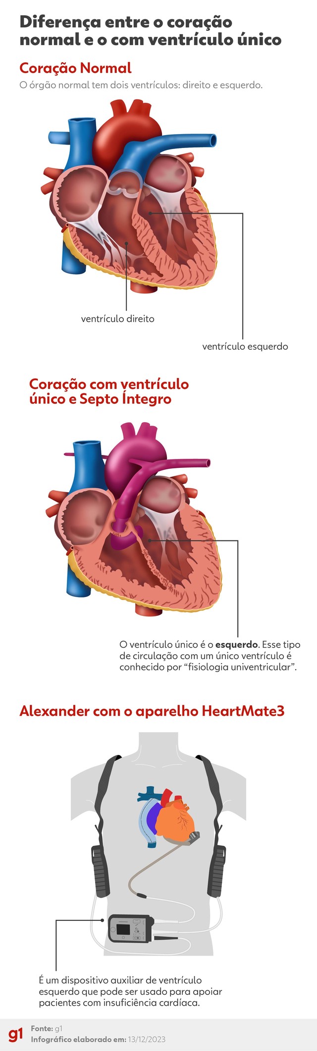 Coração com ventrículo único e Septo Íntegro 